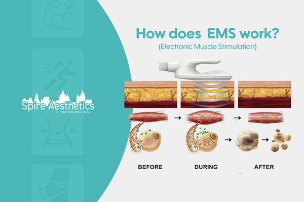 EMS treatment for post pregnancy weight loss treatment Southend