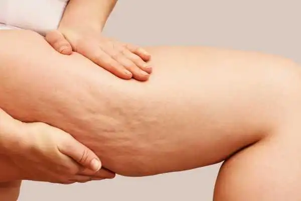 Image of woman showing leg with cellulite Southend
