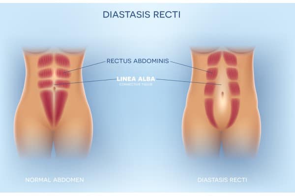 What Non-Surgical Options Are Available for Diastasis Recti Southend?