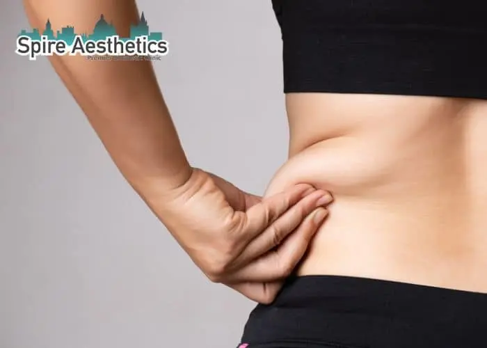 Image of woman pinching fat on their hips Southend. Fat Freezing treatment