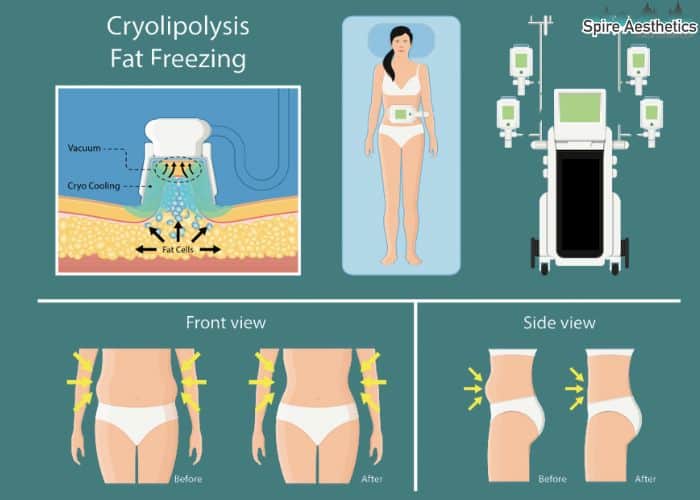 Image of diet and fat freezing combined for best results for Spire Aesthetics Southend
