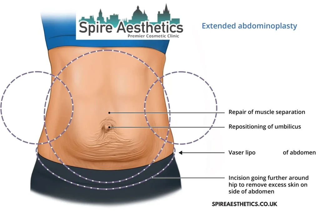 Understanding Loose Skin After Gastric Band Southend Surgery and HIFU Treatment