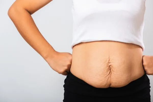 Image of a woman's stomach after weight loss with sagging skin following a gastric band Southend