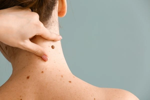 skin blemish removal Southend treatment