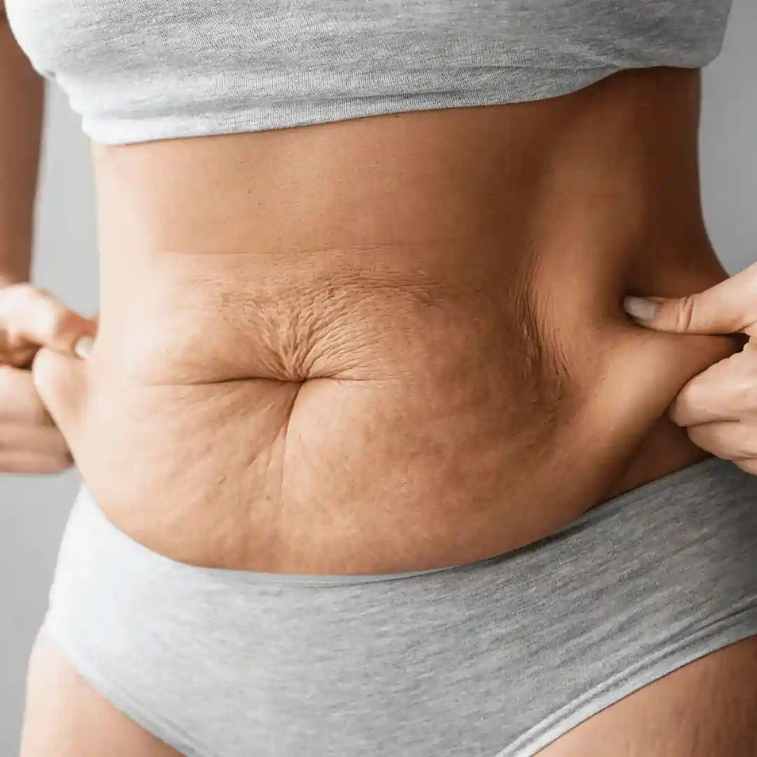 Is It Normal to Have Loose Skin After Pregnancy Southend?