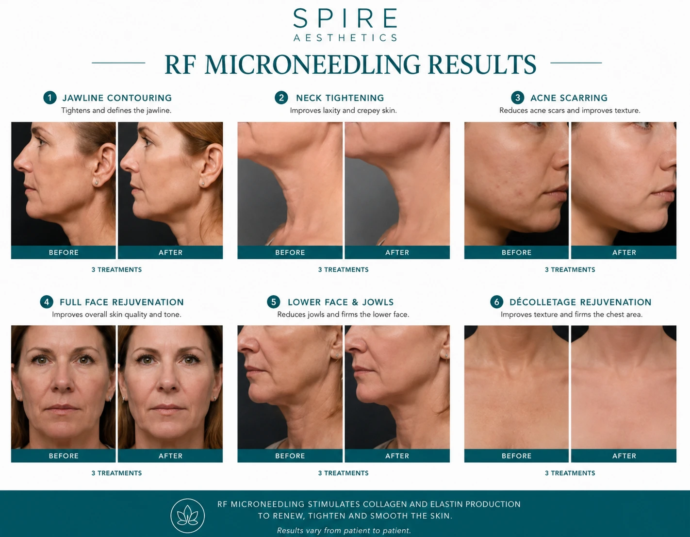 RF Microneedling Skin tightening Southend results