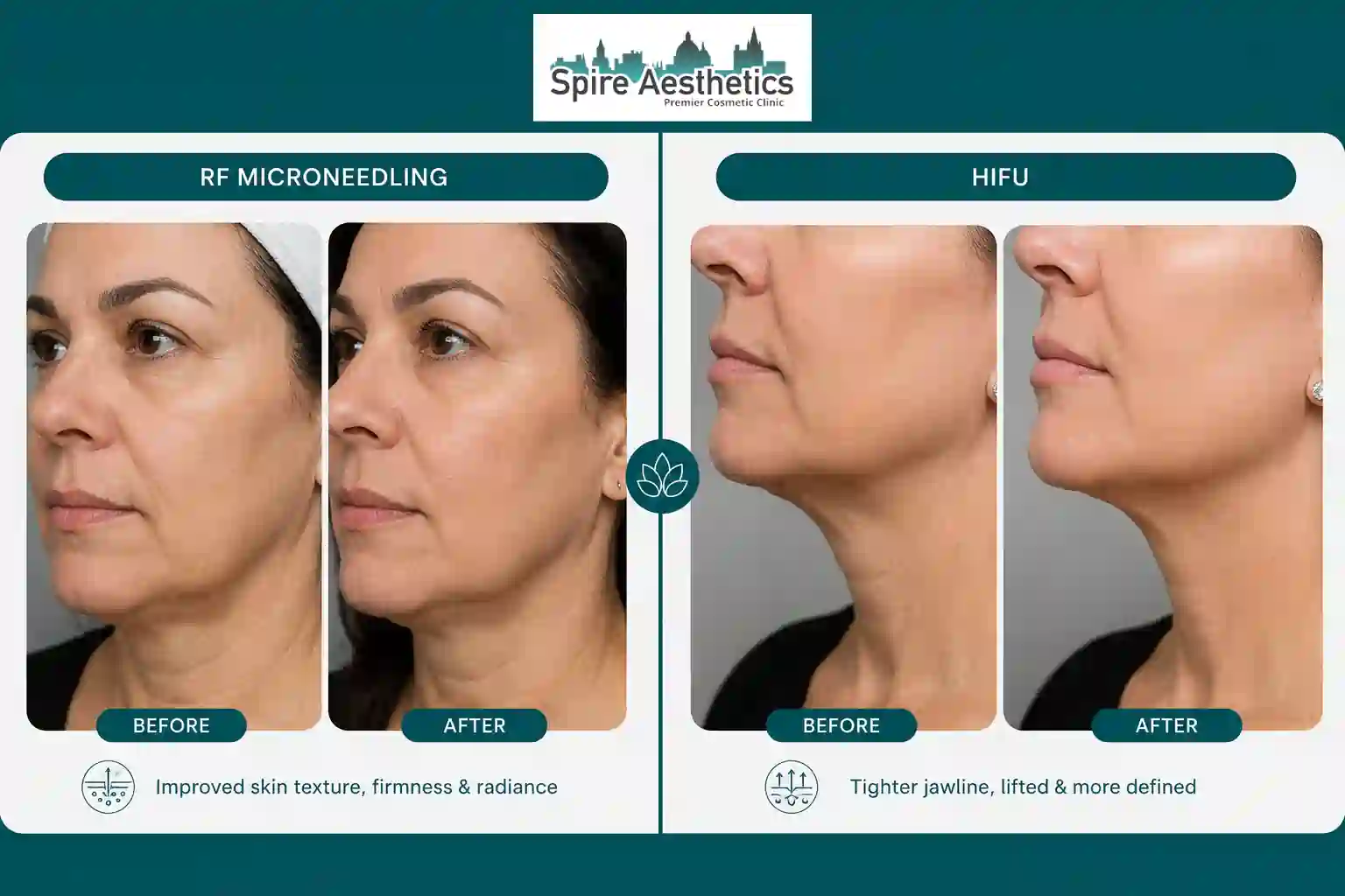 Can RF Microneedling and HIFU Be Combined Southend?