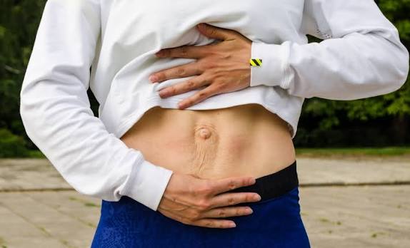 When Could Diastasis Recti Be the Missing Piece of the Puzzle Southend?