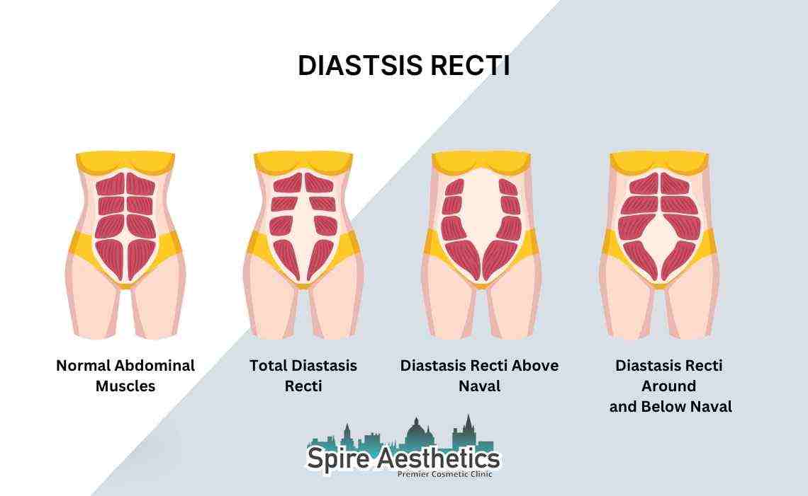 Is Non-Surgical Diastasis Recti Treatment Right for You? Common Concerns Answered Southend